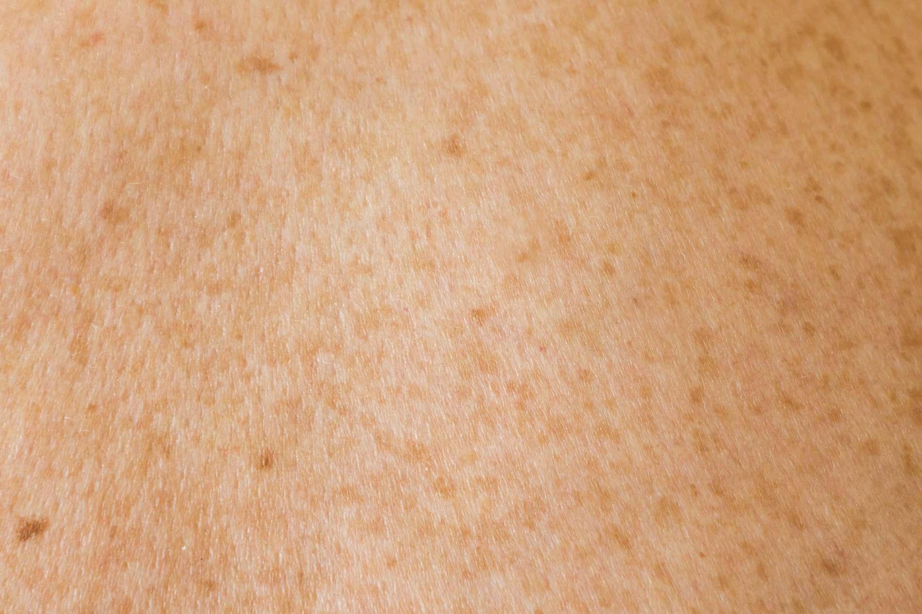 Pele morena fotografada de perto, mostrando poros e textura natural