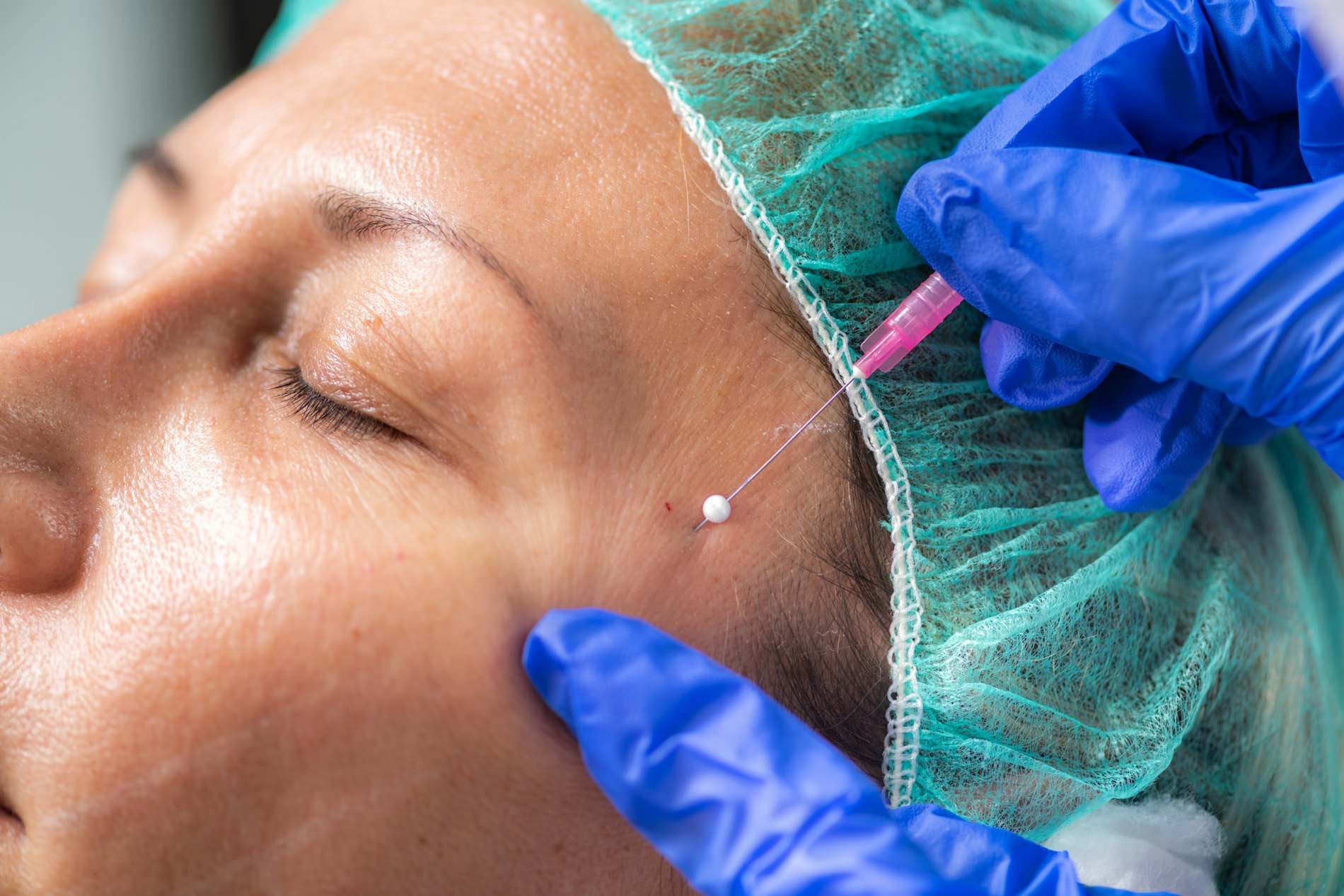 Mão de luva azul aplicando injeção na testa de uma mulher de olhos fechados